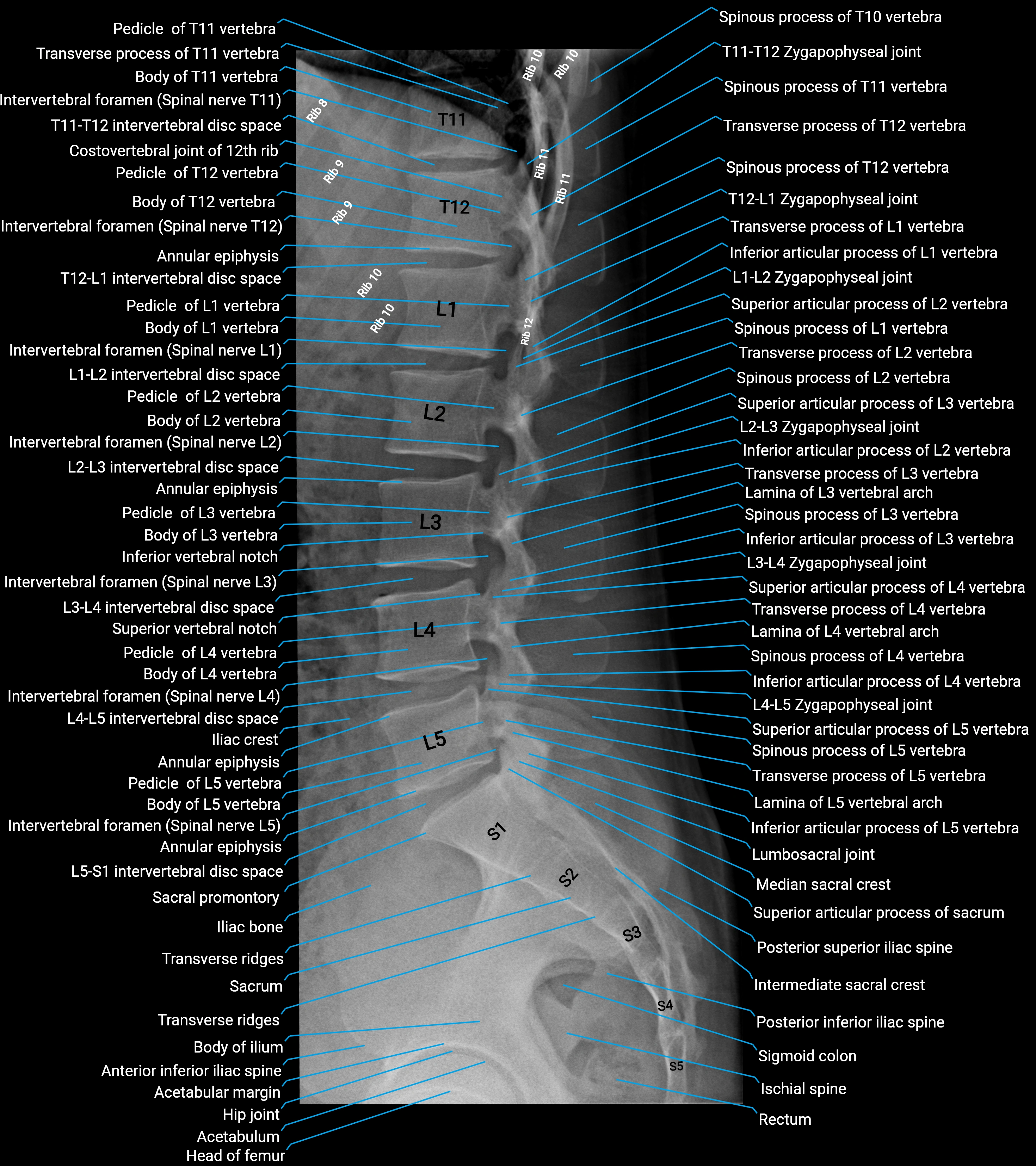 X Ray L Spine lateral anatomy.webp